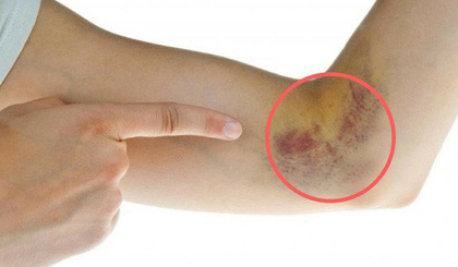 Vết thương bầm tím lâu lành lặn là lúc cơ thể báo động biểu hiện ban đầu của bệnh tiểu đường.